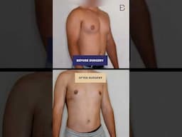 Large Gynaecomastia: Excision of Gland & VASER Liposuction {Patient 2021-7004} B&A #shorts