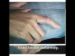Buddy taping a PIP joint injury can cause a fixed flexion deformity, where it’s unable to..