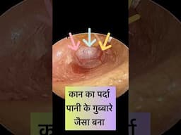 Jukaam se kaan ka parda paani waale gubbare jaisa banaa