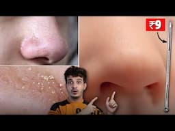 OMG! This Tool Remove Blackheads & Whiteheads Like Magic! 😱