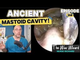 ANCIENT MASTOID CAVITY! (In a patient with a tremor!) Episode 458