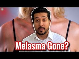 Erase Melasma with Red Light Therapy? What Dermatologists Won’t Tell You