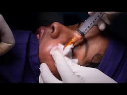 Best Fat Fillers Surgery Treatment in Bangalore