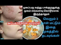 முகம் முழுக்க முகப்பரு இருந்தாலும் அதைப்போக்க 3நாள் போதும்/Pimples,Acne, Darkspot removal treatment