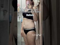 Get that flat belly! Liposuction and Tummy tuck in Korea😍 #plasticsurgerykorea #tummytucksurgery