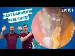 EPIC Skin Peel! Deep Ear Wax Removal with Microsuction - EP1151