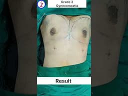 Gynecomastia/ male boobs surgery in lucknow Kanpur Meerut Varanasi jhansi mathura noida Gurugram
