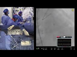 Live Case #4 - IVUS Guided PCI of Prox and mid LAD using Mini-Crush and RA