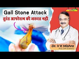 Gallstone Attack तुरंत operation की जरुरत नहीं || COMPLICATION OF GALL STONES
