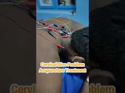 Cervical Radiclopathy Acupuncture Treatment#chiropractic #naturaltreatment #ringdinger