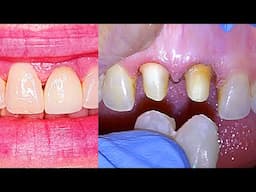 Dentist FIXES BLACK TRIANGLE on FRONT TEETH with ANTERIOR CROWNS & GINGIVECTOMY! Full Procedure 🦷😁