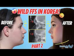 How is this even possible? Facial Feminization Surgery in Korea P.2 |  Male to Female Transformation