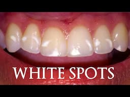 How A Dentist Removes White Spots On Teeth From Braces! Treatment to Get Rid of Remineralized Stains