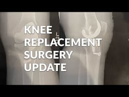 From Patient to Provider: Part 3 of Dr. Warwick’s Knee Surgery Recovery Story