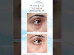 When Eye Bags Can be Treated with Filler #eyebags