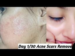 Day 1/30 Remove Acne Scars || 32% chemical peel at home for acne scars || #चेहरेकेगड्ढे
