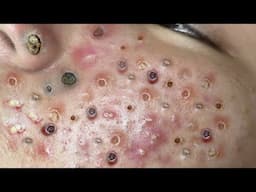 Loan Nguyen Acne Treatment 73x