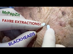 FAVRE-RACOUCHOT Blackhead extractions! Thickened skin pore plugs removed. Pore cleansing activated!