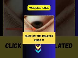 What is Munson's Sign? # keratoconus