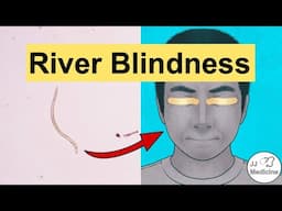 River Blindness (Onchocerciasis) | Causes, Pathophysiology, Signs & Symptoms, Diagnosis, Treatment