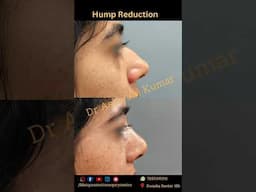 Open Rhinoplasty for Tip Narrowing and Dorsal Hump Reduction. Call on 7290062111