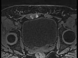 Abdominal wall Endometriosis