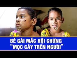 Bé gái mắc hội chứng “mọc cây trên người”