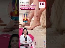 Bulging veins in your legs? Here's what it means! – Explained by Dr. Anusha Bingi