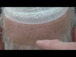 FUT Linear Scar Healing Example – Real Hair Transplant Result | Dr Diep
