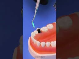 How tooth removal works at the dentist