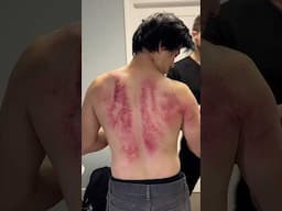 Holy Smokes 😳 Cracks & Insane Gua Treatment! #shorts #chiropractor