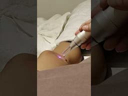 start of my scar laser journey #scar #laser #removal #treatment #vietnam #price #beforeandafter