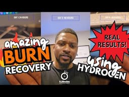 Burn Recovery in 4 Days with Hydrogen Therapy (Real Results)
