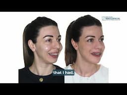 Bimaxillary Surgery Case #166: Brittany-  Class II, maxillo-mandibular retrusion, Dental crowding
