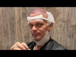 We came to Turkey for Hair Transplant Surgery... Bad Chad gets 5,200 grafts in a 8 hr procedure! 🤕💈