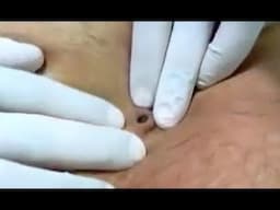 Naval Stone Removal - Like Massive Blackhead! Belly Button Discharge -SUPER PLUG
