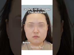 These are THE ✨#jawlinegoals ✨Korean Plastic Surgery gets it as always!💕 #doublechinremoval