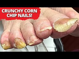 Cutting THICK Nails on Both Pinky Toes 😳 | Oddly Satisfying!