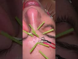 Surgeons Can’t Stand This Facelift
