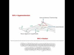 Boutonnière deformities, like Karim Benzema’s, can occur quickly (within 2-3 weeks) when a central..
