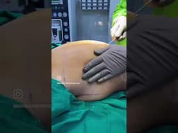 Back Liposuction Treatment in Navi Mumbai | Get Rid of Stubborn Back Fat in 1 Minute 💯