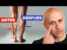 5 CLAVES para EVITAR las VARICES HOY MISMO