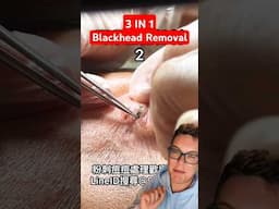 Unmissable BLACKHEAD REMOVAL - 3in1 Ear Blackheads #shorts