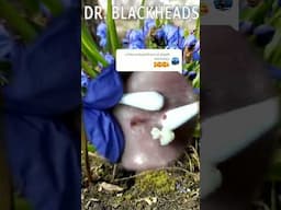 Blackheads Removal | Acne Treatment and Very Satisfying Satisfying Pimple pop #blackheads