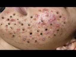Loan Nguyen Acne Treatment 69x