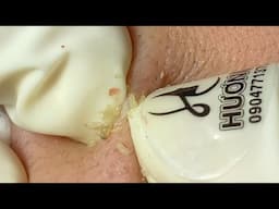 Acne Treatment Huong Da Nang#728 Blackhead removal