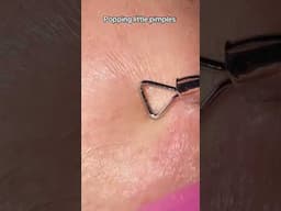 1 Minute Of Top ASMR Pimple Popping Video №108