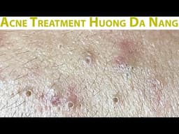 Acne Treatment Huong Da Nang#732 Have a nice weekend!