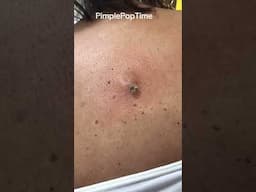 1 Minute Of Top ASMR Pimple Popping Video №110