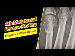 🔵 4th Metatarsal Fracture Healing Progress | 7-Week Recovery Update & X-Rays 🔵